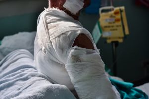 burn injuries from car accident